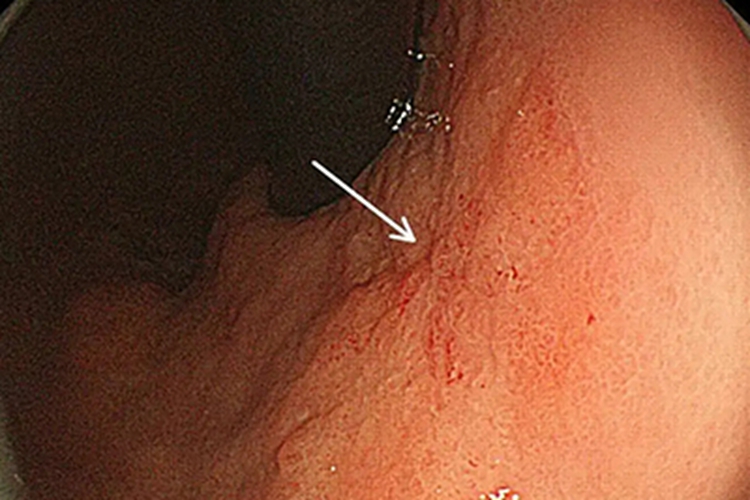 胃癌胃镜检查图
