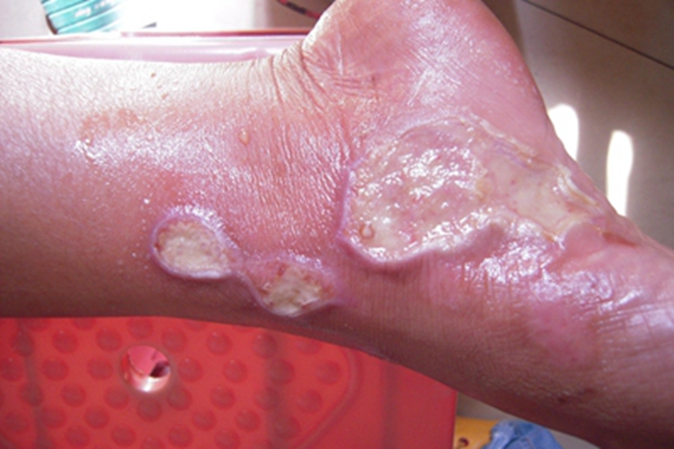 深Ⅱ度烧伤脚部红肿图