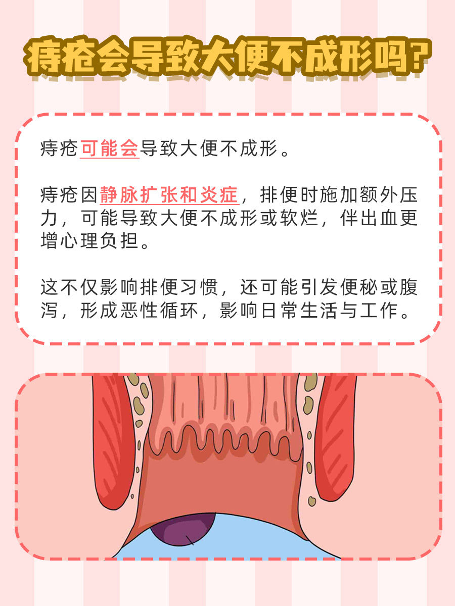 一文探究:痔疮是否会导致大便不成形?