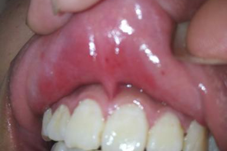 复发性口腔溃疡图