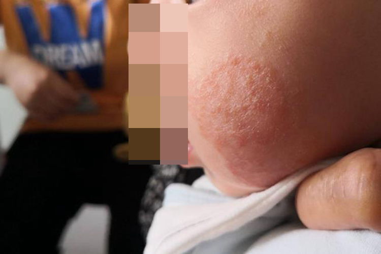 孩子过敏皮肤丘疹图