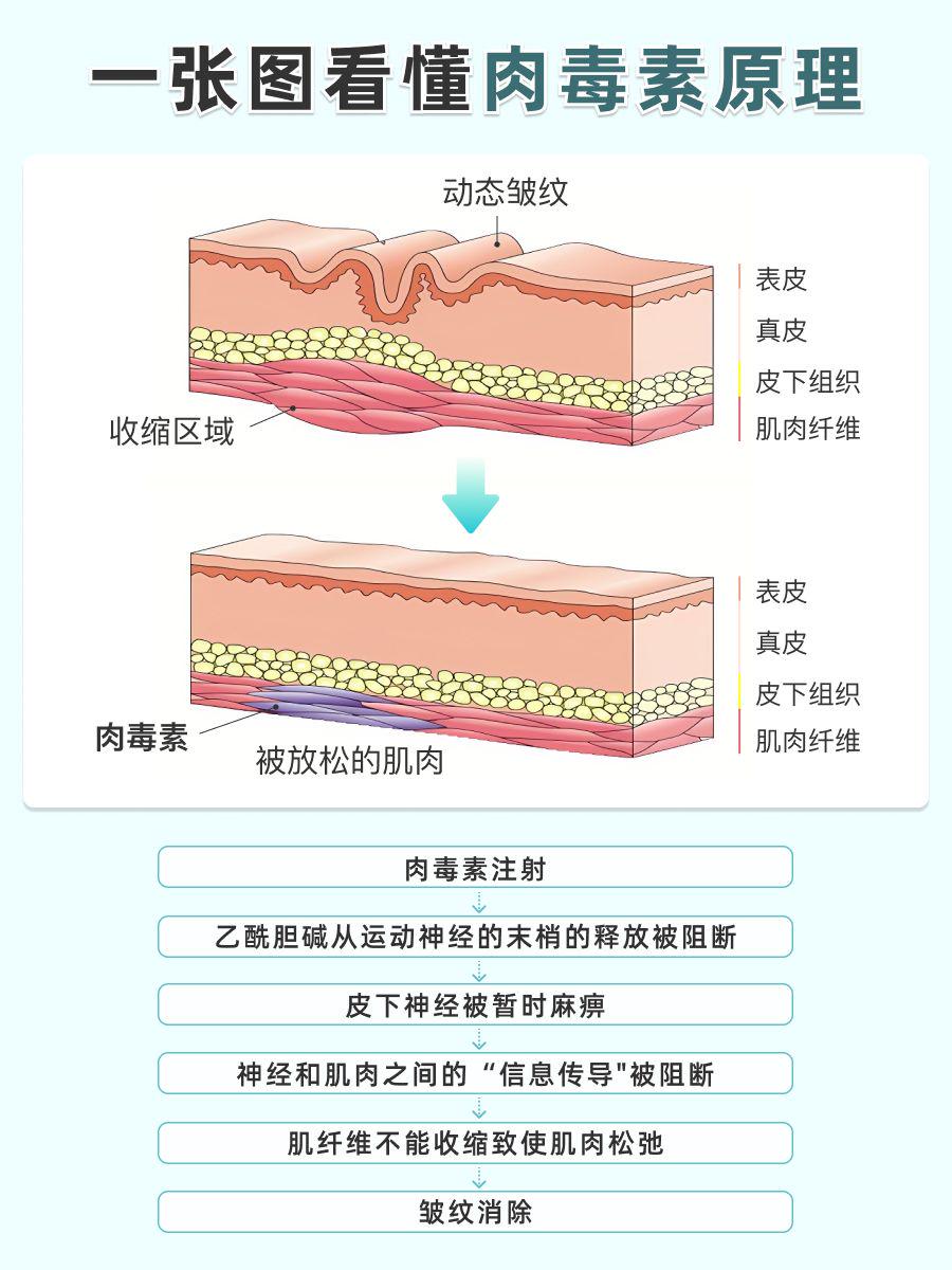 杭州肉毒素攻略：价格透明化+安全变美指南