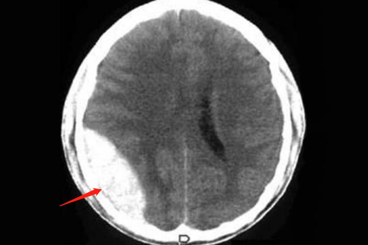 硬膜外血肿CT图 硬膜外血肿CT图