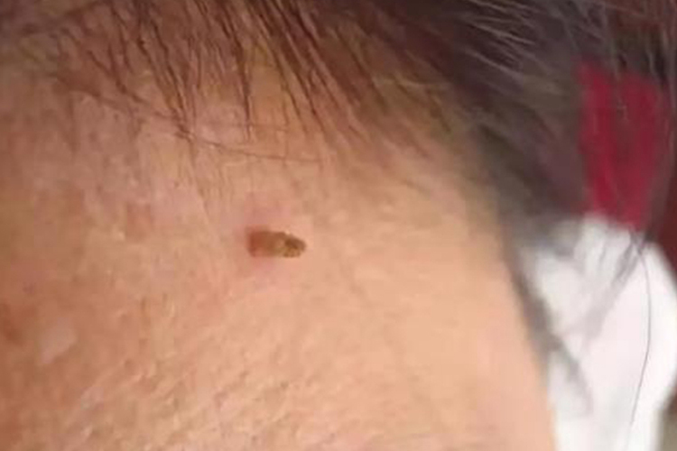 男性颈部丝状疣图