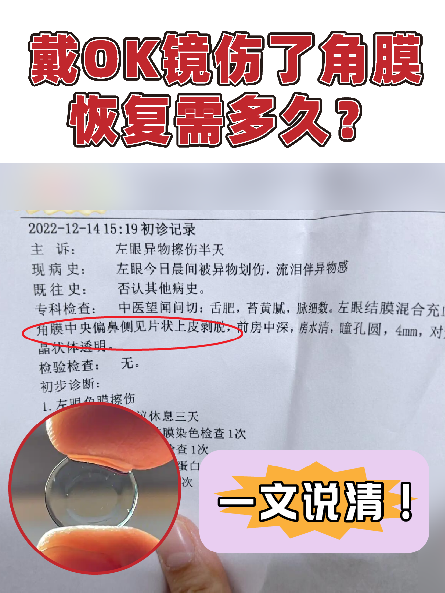 戴OK镜伤了角膜，恢复需多久？一文说清！