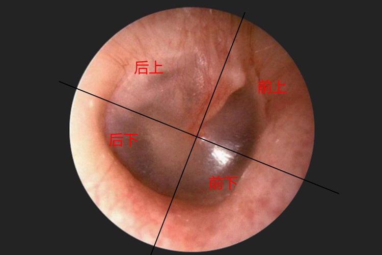 鼓膜象限分区图