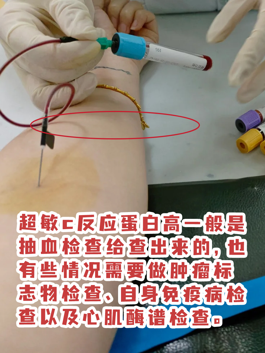 超敏c反应蛋白是啥？升高怎么办