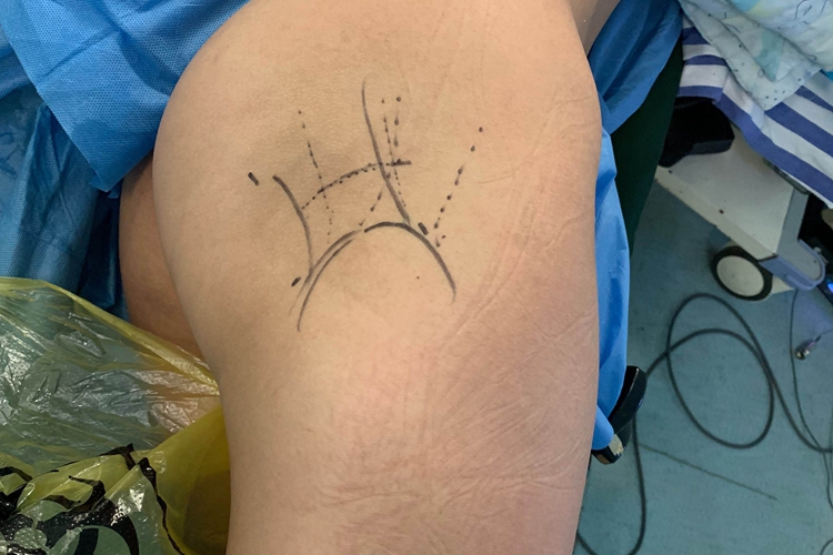 臀肌挛缩症臀部凹陷图