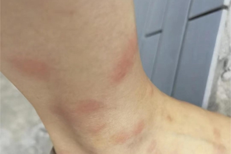 蚊虫叮咬脚踝红斑图 蚊虫叮咬脚踝红斑图