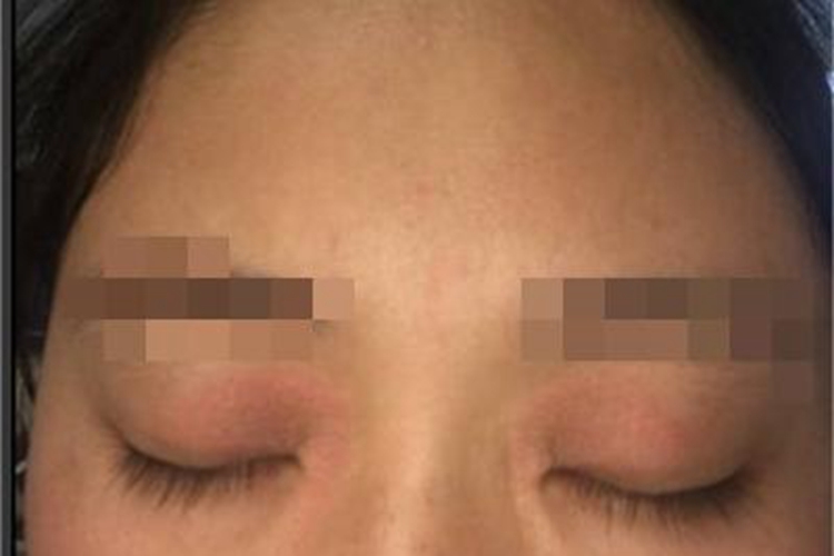 慢性眼睑湿疹眼睑红斑图