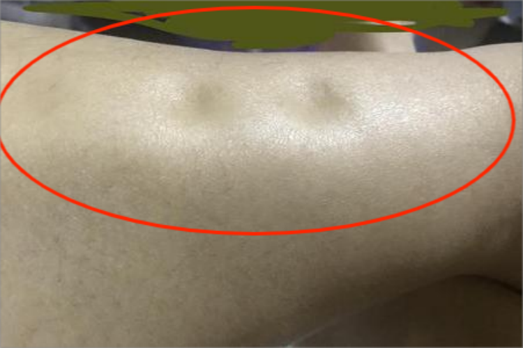 营养不良性水肿图