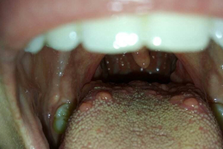 舌乳头炎图 舌乳头炎图