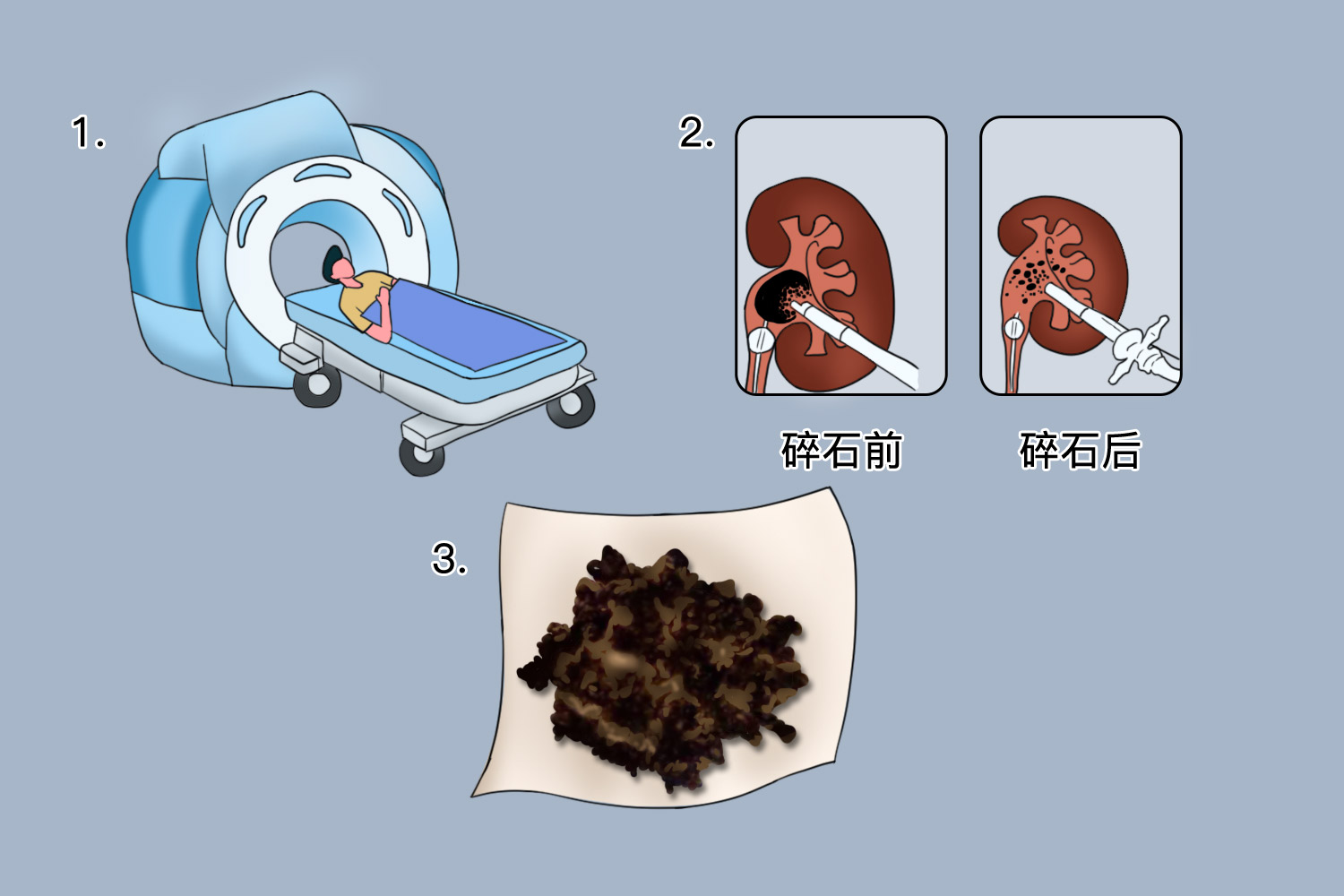 激光打结石过程图