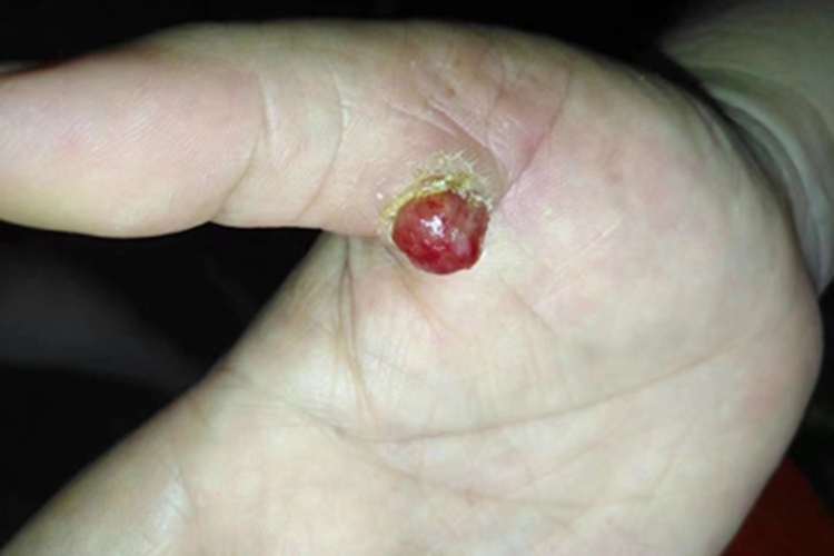 化脓性肉芽肿圆疙瘩图 化脓性肉芽肿圆疙瘩图