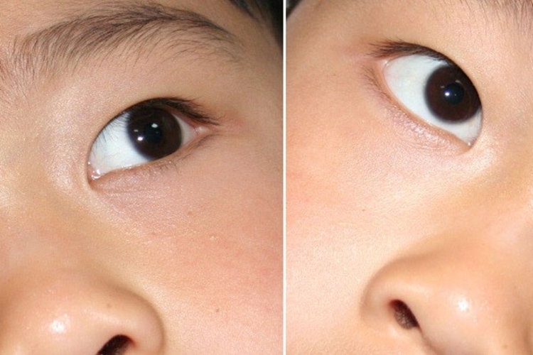 先天性上斜肌麻痹代偿头位图