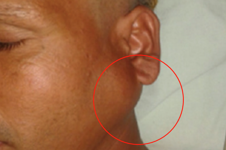 潴留性腮腺囊肿耳前包块图