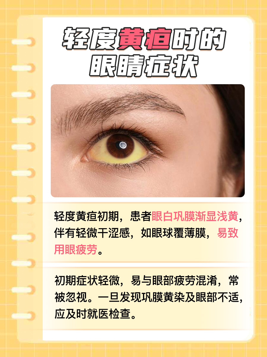 轻度黄疸眼睛图片