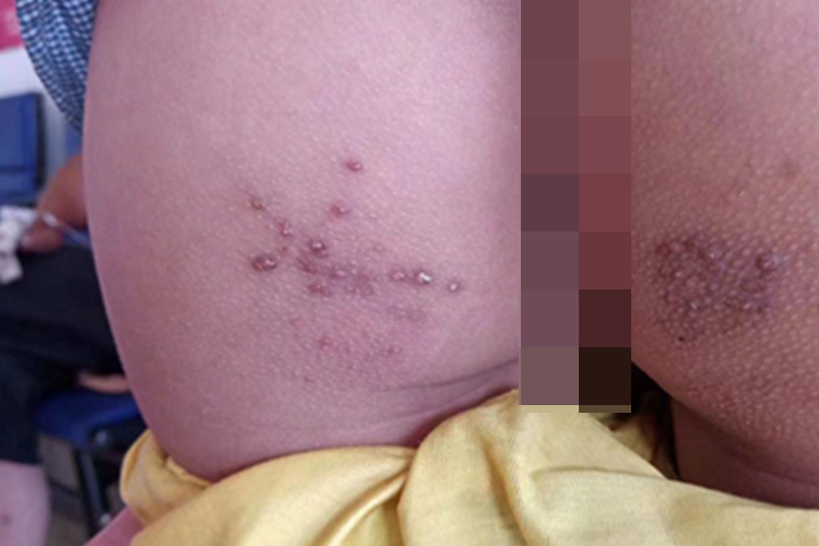 慢性湿疹臀部有暗红色丘疹图