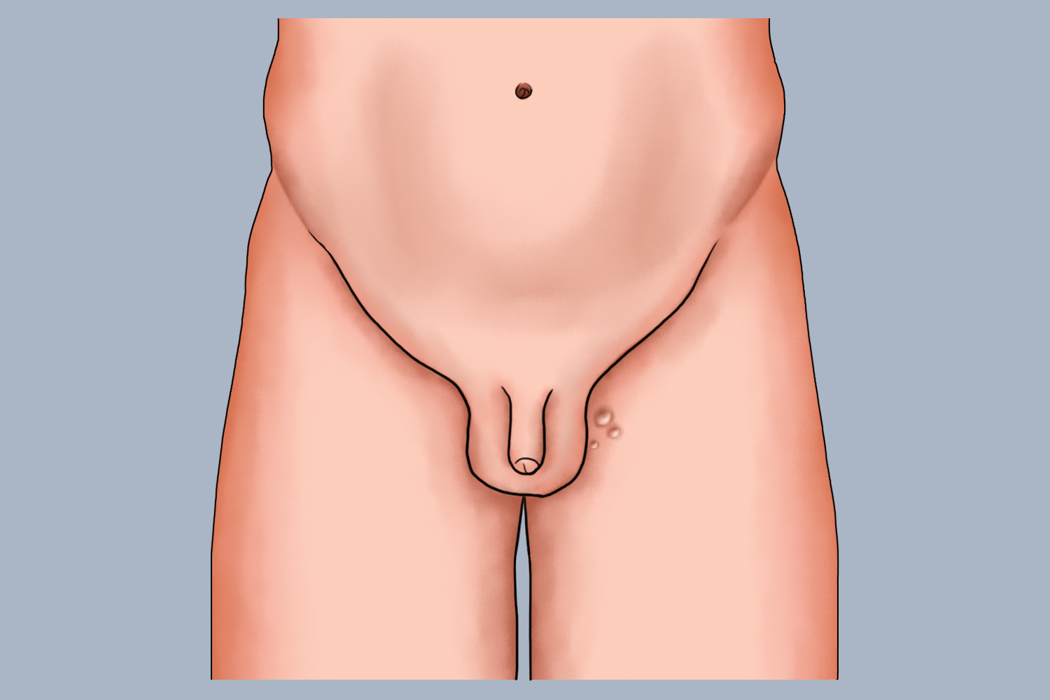 腹股沟脂肪瘤图