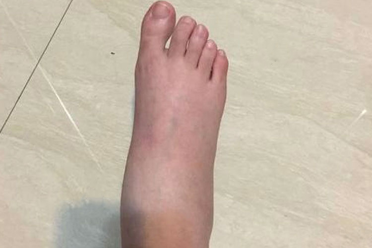 脚部肿胀图 脚部肿胀图