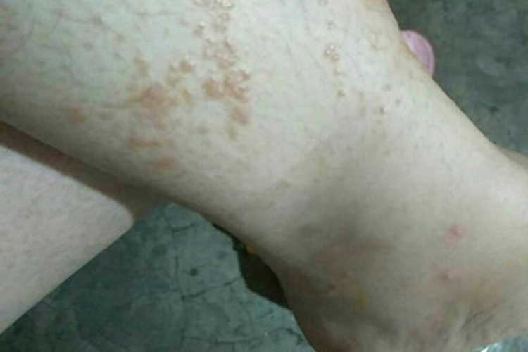 疱疹样皮炎小腿症状图