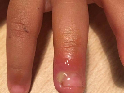 手指头细菌感染肿图片图片