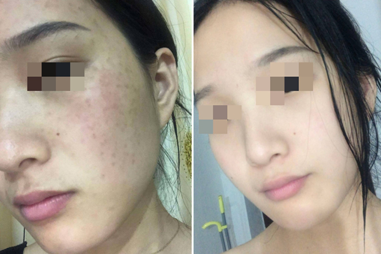 祛斑前后对比图 祛斑前后对比图