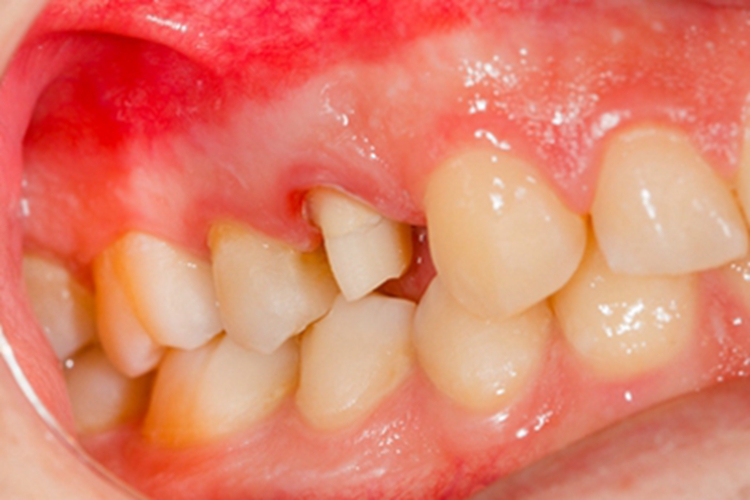 牙龈退缩露出牙根牙龈很红图