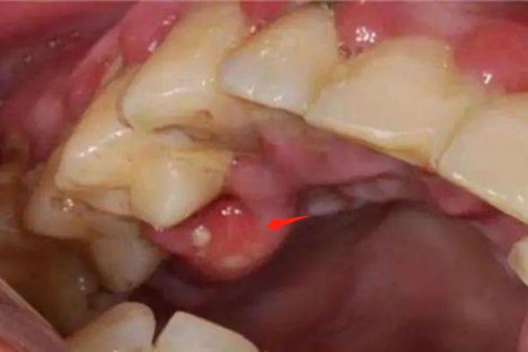 急性牙周脓肿图