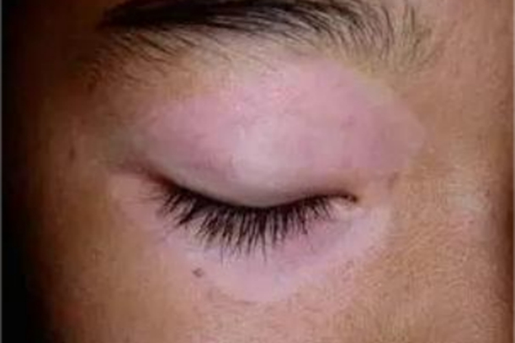 稳定期节段型白癜风白斑图 稳定期节段型白癜风白斑图