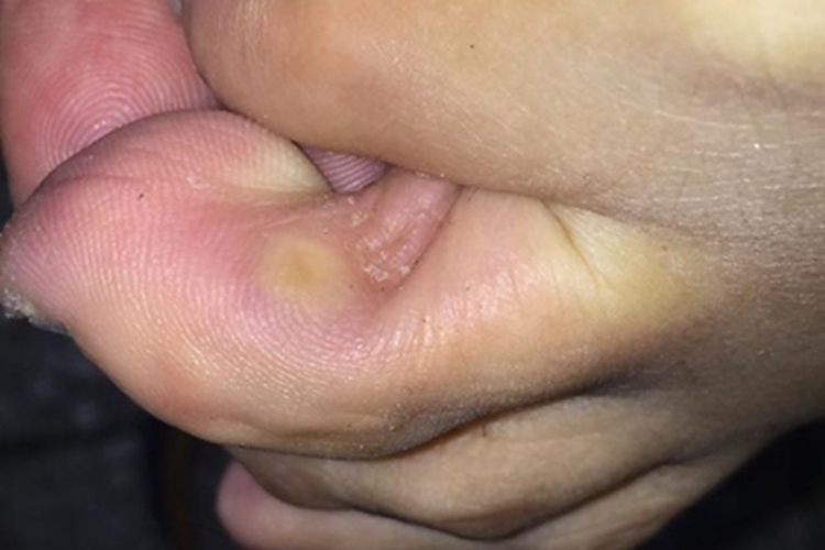 软鸡眼脚趾缝症状图