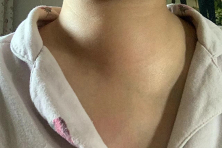 鳃裂囊肿症状图