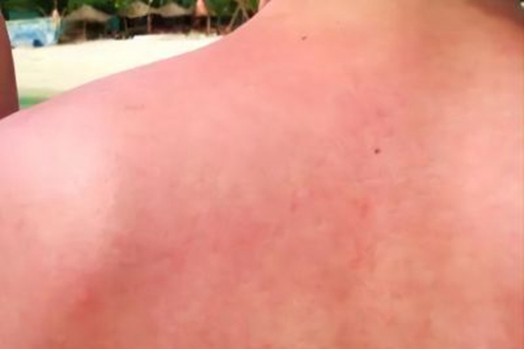 日照性皮炎背部潮红图