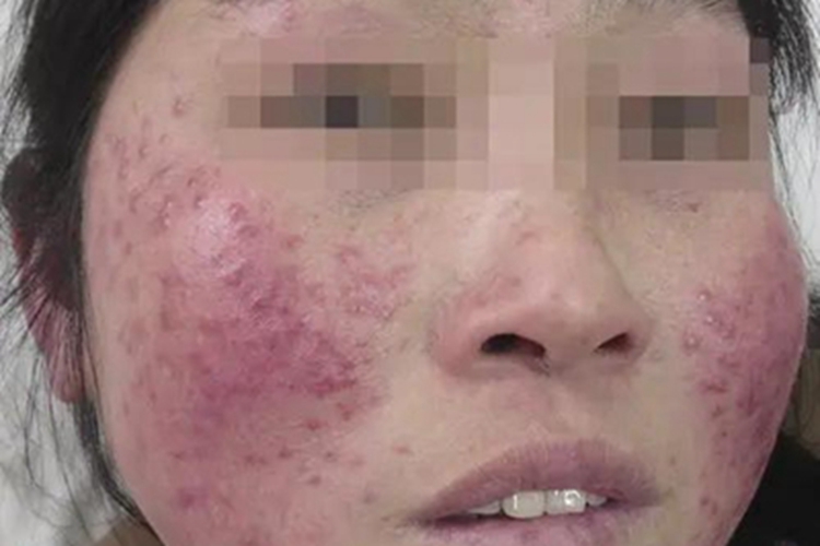 结核性苔藓面部症状图