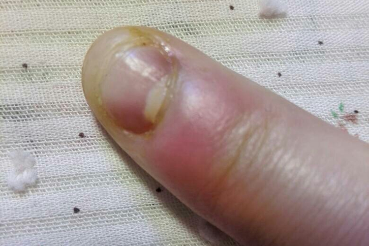 脓性指头炎图
