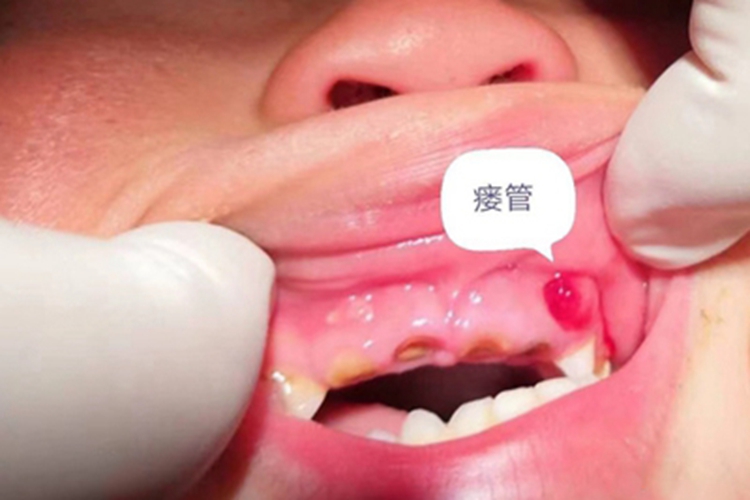 猖獗龋牙龈大窟窿图 猖獗龋牙龈大窟窿图