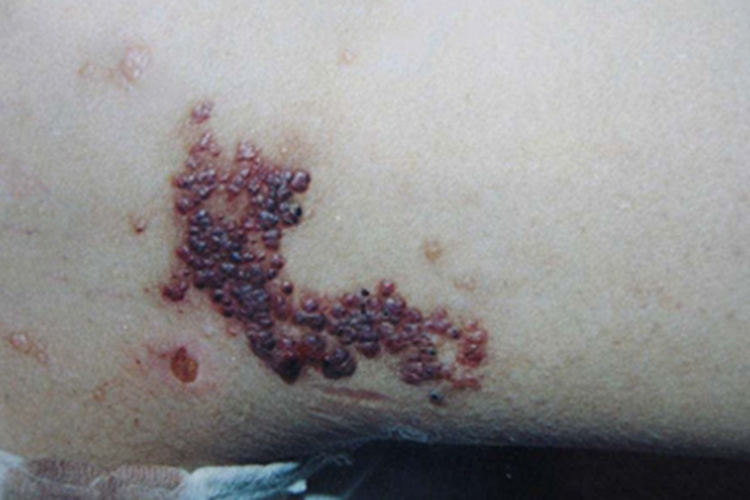 弥漫性躯体性血管角化瘤症状图