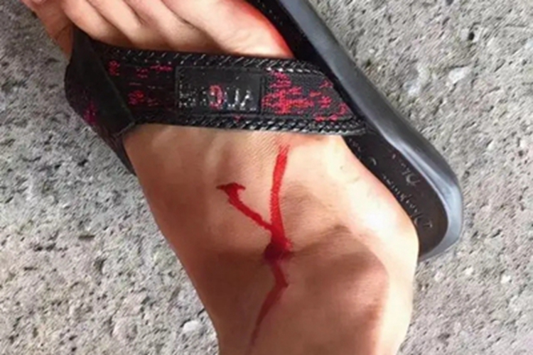 毒蛇咬伤脚背血点图