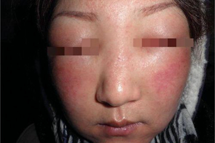 感染型化妆品皮炎水肿图