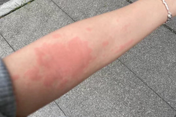 海鲜过敏胳膊上长红斑图 海鲜过敏胳膊上长红斑图