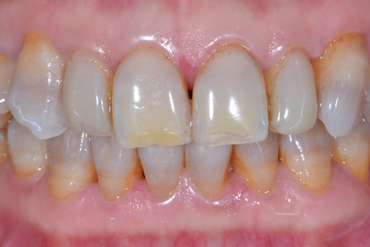 中度四环素着色图 中度四环素着色图