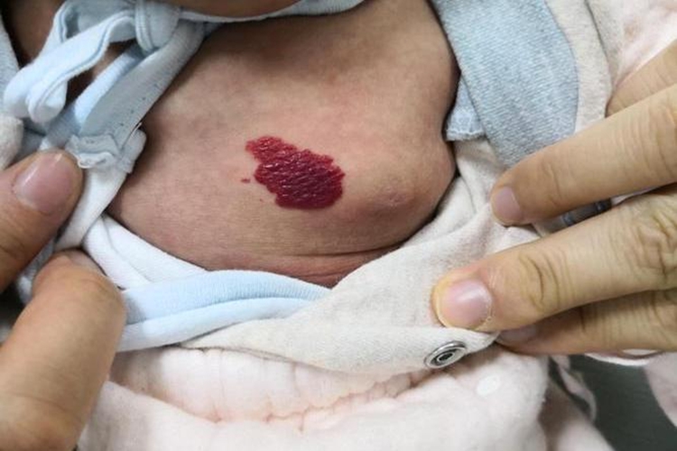 胸部血管瘤图 胸部血管瘤图