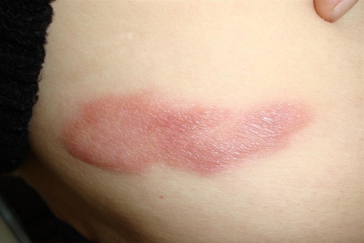 结核样型麻风皮肤增厚图 结核样型麻风皮肤增厚图