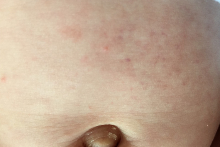 婴儿腹部瘀点图