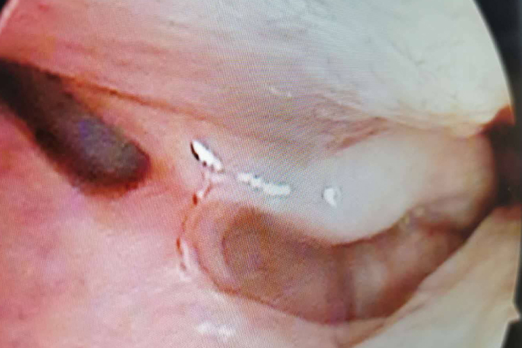 过敏性鼻炎图 过敏性鼻炎图