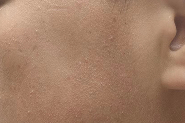 毛发角化病脸颊有皮疹图