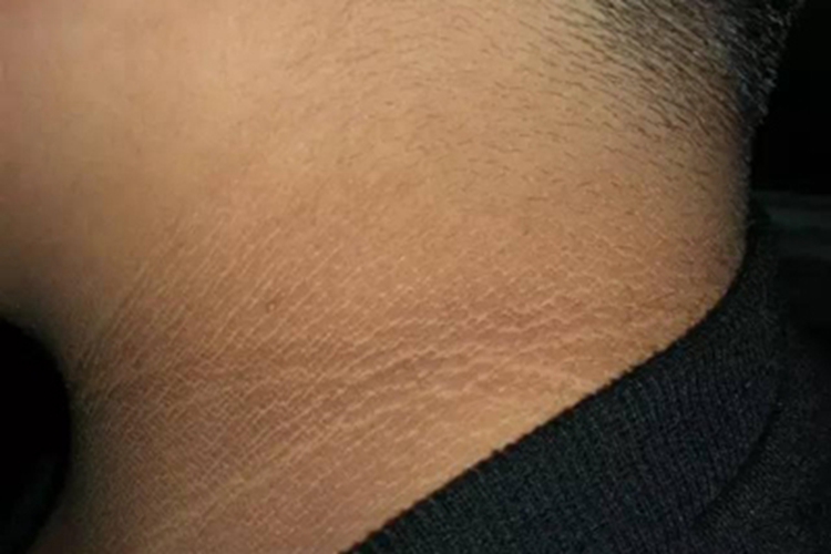 假性黑棘皮病颈部纹路发黑图