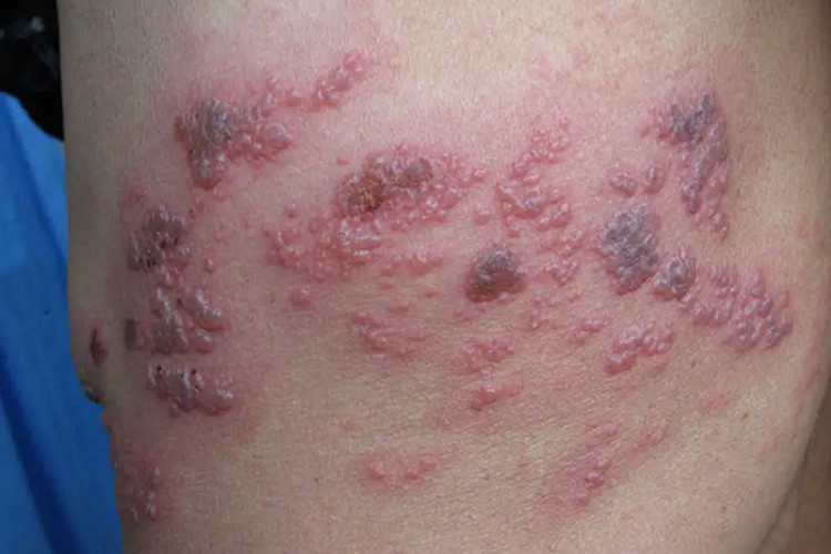 艾滋病带状疱疹图 艾滋病带状疱疹图