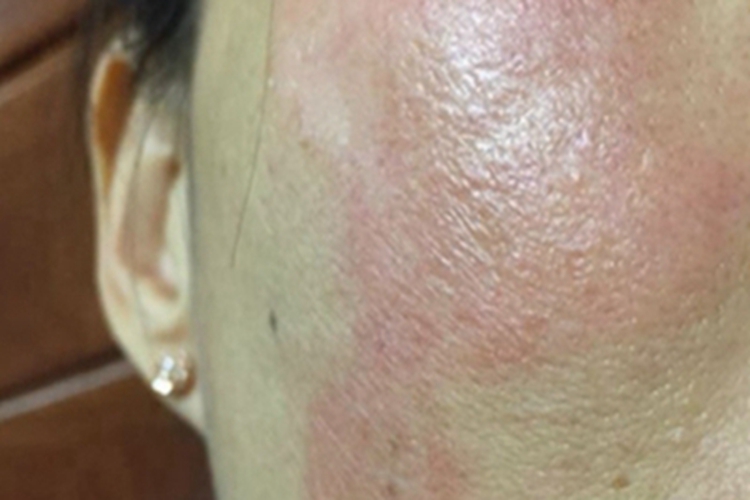 面部变应性接触性皮炎面部红了图 面部变应性接触性皮炎面部红了图