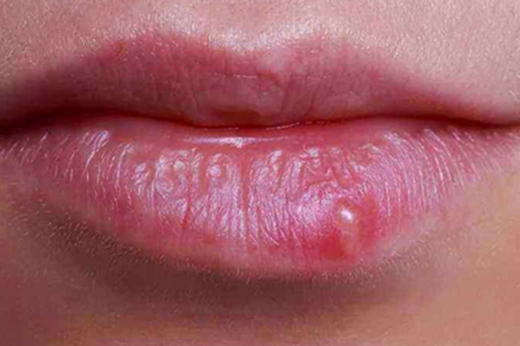 浆细胞性唇炎小水疱图 浆细胞性唇炎小水疱图
